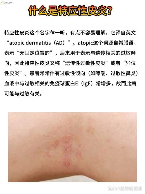 什么是tele,什么是特应性皮炎